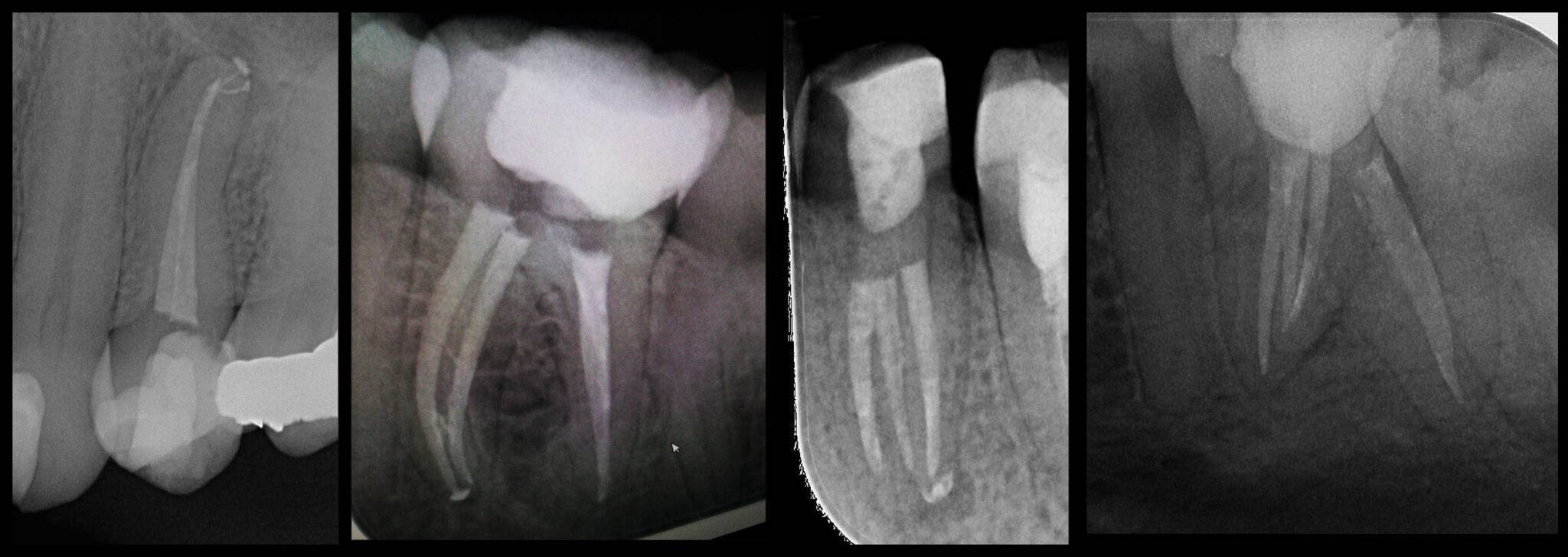 Endodoncie – mikroskopické ošetření kořenových kanálků Praha
