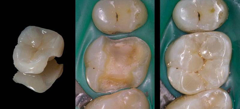 Overlay – keramická výplň zubu AS Dental Clinic Praha