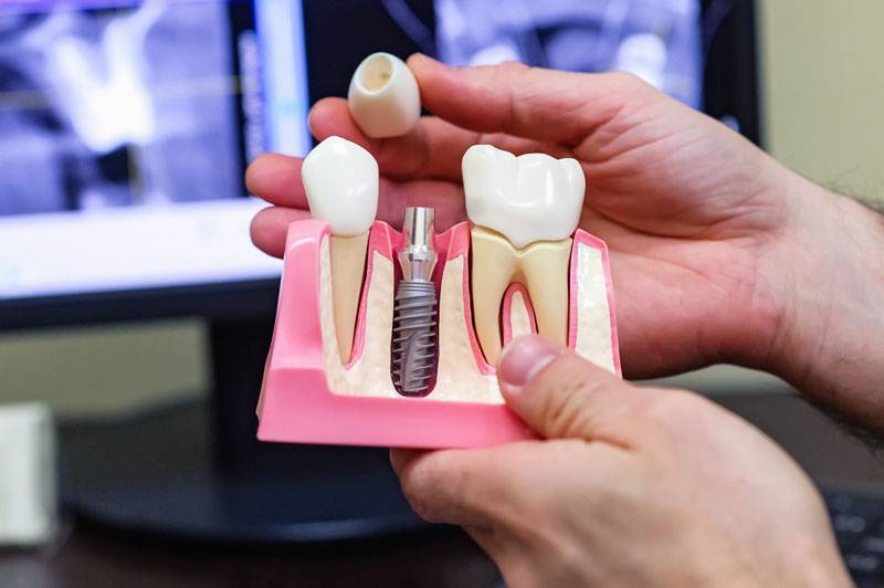 Zubní implantáty – AS Dental Clinic Praha