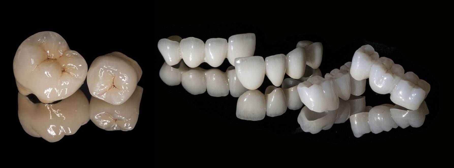 Korunky a můstky – zubní náhrady AS Dental Clinic Praha